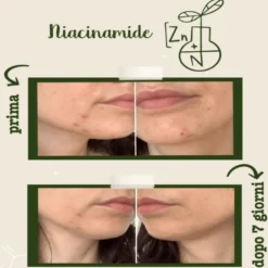 Niacinamide + Zinco