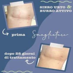 Trattamento smagliature